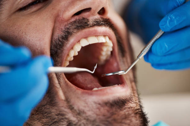 Best Knocked-Out Tooth (Avulsed Tooth) Treatment in Vernonia, OR